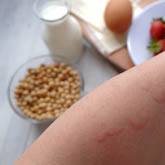 Food Allergies