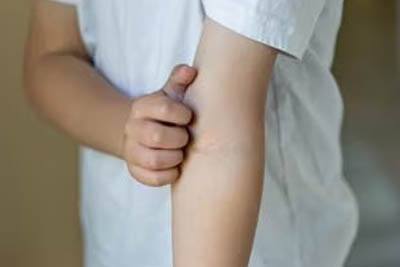 Children Eczema causes