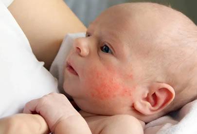 Children Eczema Homeopathic treatment