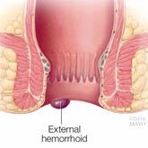 External Hemorrhoids
