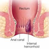 Internal Hemorrhoids
