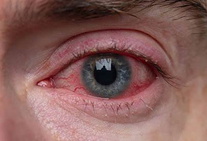 Blepharitis Homeopathic treatment