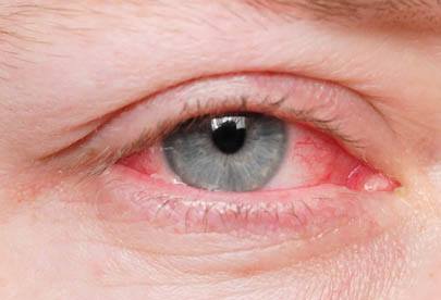 Conjunctivitis (Pink Eye) Homeopathic treatment