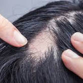Alopecia Treatment