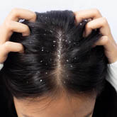Dandruff Treatment