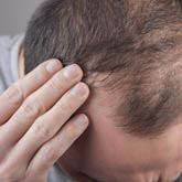 Hair Loss Treatment