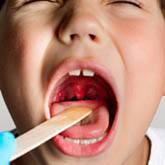 Acute Tonsillitis