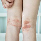 Atopic Dermatitis