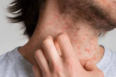 Dermatitis causes
