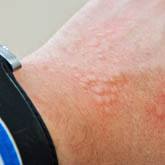 Contact Dermatitis