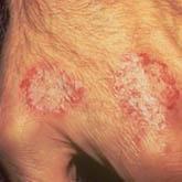 Nummular Dermatitis