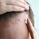 Seborrheic Dermatitis