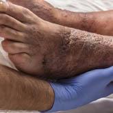 Stasis Dermatitis