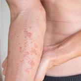 Atopic Dermatitis