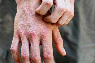 Eczema causes