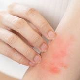 Contact Dermatitis