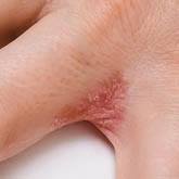 Dyshidrotic Eczema