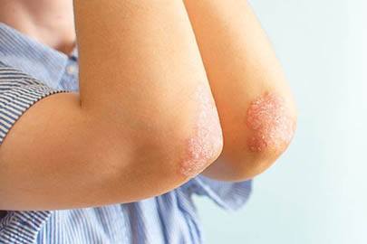 Eczema Homeopathic Treatment