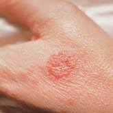 Nummular Eczema