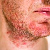 Seborrheic Dermatitis