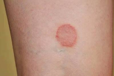 Lichen Planus causes