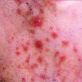 Cutaneous Lichen Planus