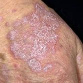Genital Lichen Planus