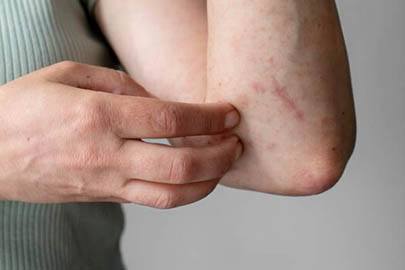 Lichen Planus Homeopathic Treatment