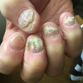 Nail Lichen Planus