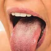 Oral Lichen Planus