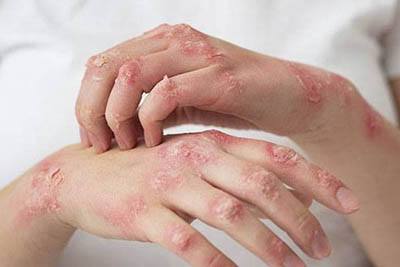 Psoriasis causes