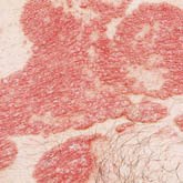 Erythrodermic psoriasis