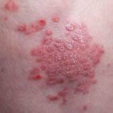 Guttate psoriasis