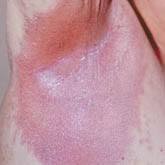 Inverse psoriasis