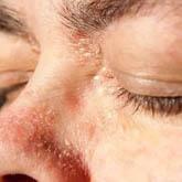 Plaque psoriasis