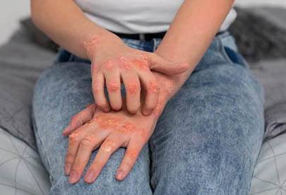 Psoriasis Homeopathic Treatment
