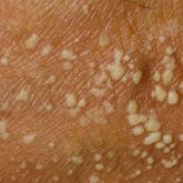Pustular psoriasis
