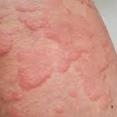 Acute Urticaria