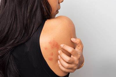 Urticaria causes