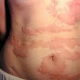 Chronic Urticaria