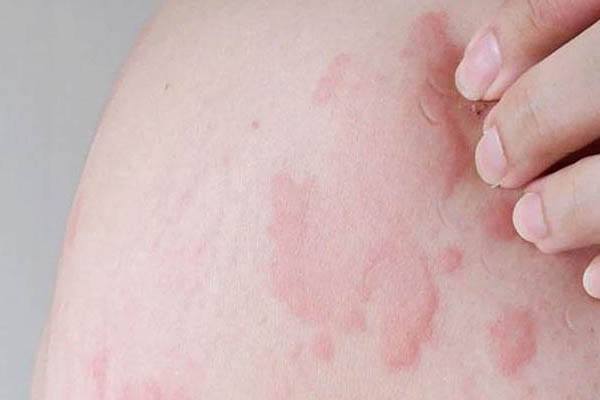 Urticaria Homeopathic Treatment