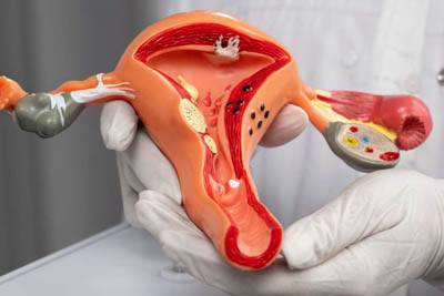 Fibroids causes